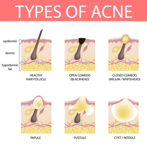 How to get rid of acne: causes, treatments and prevention - SHOPPE.LK