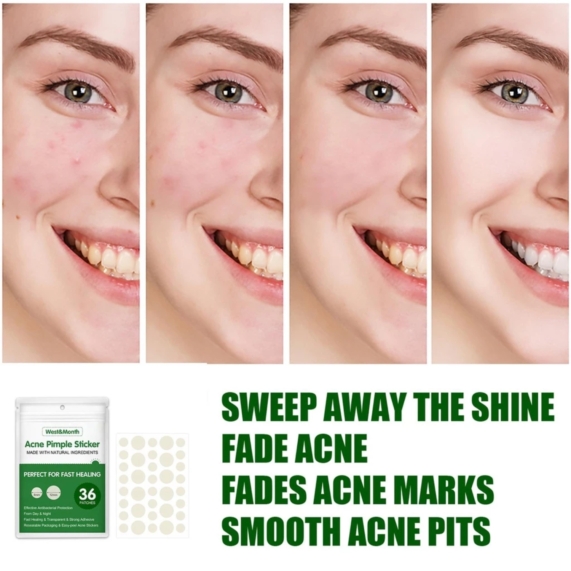 Acne Pimple Patch Sticker 36Pcs – Invisible & Fast Healing Acne with Natural Ingredients - SHOPPE.LK